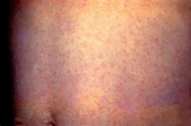 Image result for Rubella Pictures