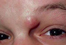 Image result for Sebaceous Cyst Eyelid