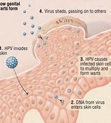 Image result for Human Papillomavirus HPV Signs and Symptoms