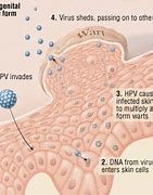 Image result for Genital Human Papillomavirus Stages