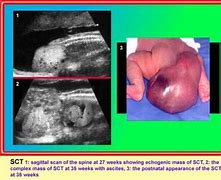 Image result for Mucinous Borderline Tumor Ovary