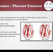 Image result for Early Sign Throat Cancer