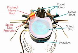 Image result for Exiting Nerve Root