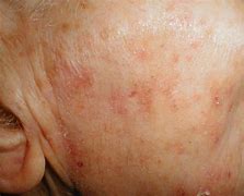 Image result for Solar Keratosis