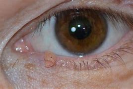 Image result for Limbal Papillomas