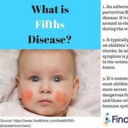 Image result for Fifth Disease in Adults Symptoms