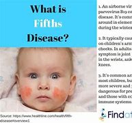 Image result for Fifth Disease Kids