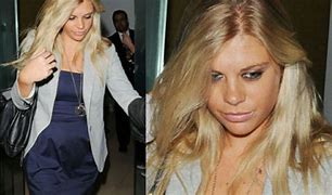 Image result for Chelsy Davy Plastic Surgery