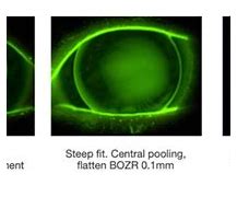 Image result for Toric Lens