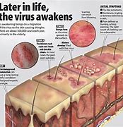 Image result for Stages of Shingles Healing