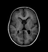 Image result for Lissencephaly Patho