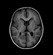 Image result for Lissencephaly in Adults