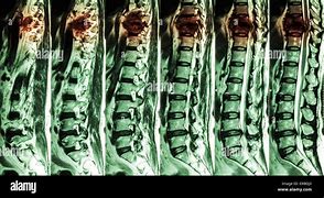 Image result for Axial T2 MRI Lumbar Spine