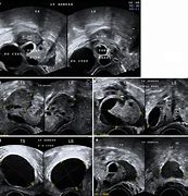 Image result for Adnexal Cyst with Polyp Ultrasound