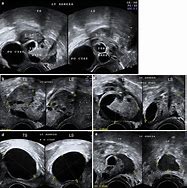 Image result for Right Adnexal Cyst 9Mm