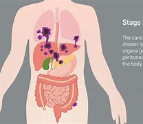 Image result for Stage 4 Colon Cancer Symptoms