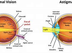 Image result for Astigmatism Eye