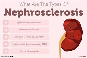 Image result for Nephrosclerosis