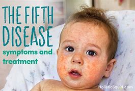 Image result for Fifth Treatment 5th Disease