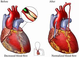 Image result for Heart Bypass Surgery Procedure