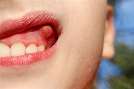 Image result for Papilloma on Gums