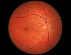 Image result for Right Eye Retina