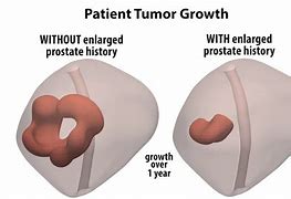Image result for Size of Prostate Tumor