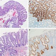 Image result for Sessile Colon Polyp