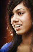 Image result for Braces Before and After