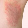 Image result for Mold Allergy Skin Rash