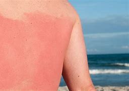 Image result for Sun Burn Go a Day Pics