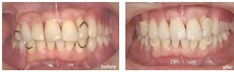 Image result for acatal�ctick