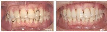 Image result for acatal�ctido