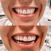 Image result for Invisalign Before and After Pics