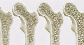 Image result for Bone Density Scan