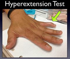 Image result for Hyperexsion Drop Test