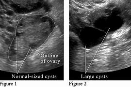 Image result for Functional Ovarian Cyst