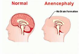 Image result for Anencephaly and Rachischisis
