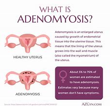 Image result for Adenomyosis