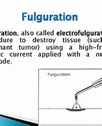 Image result for fulguraci�n