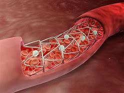 Image result for Vascular Stent Surgery