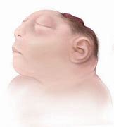 Image result for Anencephaly Folate