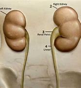 Image result for Parapelvic vs Peripelvic Cyst