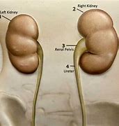 Image result for Complex Cyst On Kidney Right Low Pole