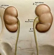 Image result for Waht Is Renal Cyst