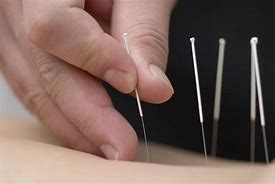 Image result for Chinese Acupuncture