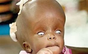 Image result for Child with Hydrocephalus