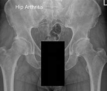 Image result for left hip
