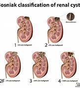 Image result for Large Renal Cyst