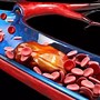 Image result for Blood Clot the Size of a Apple